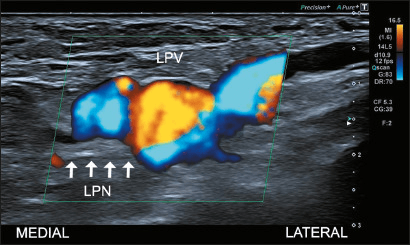 Colour Doppler ultrasound of a dilated lateral plantar vein in contact with the lateral plantar nerve