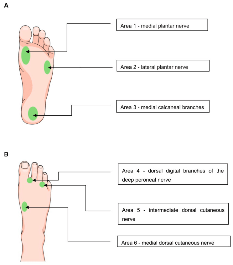 Foot diagrams marking three plantar sensory testing areas for the medial plantar, lateral plantar and medial calcaneal branches and three dorsal areas for peroneal nerve branches