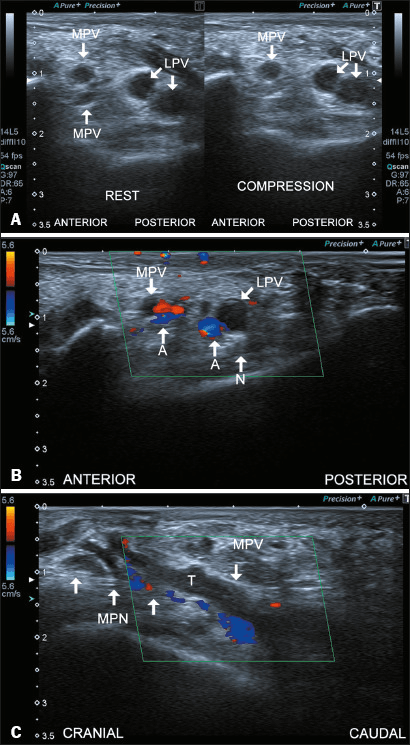 Ultrasound of plantar vein thrombosis: compression views with one medial plantar vein collapsing, colour Doppler without flow in the medial and lateral plantar veins, and a thrombus beside the medial plantar nerve