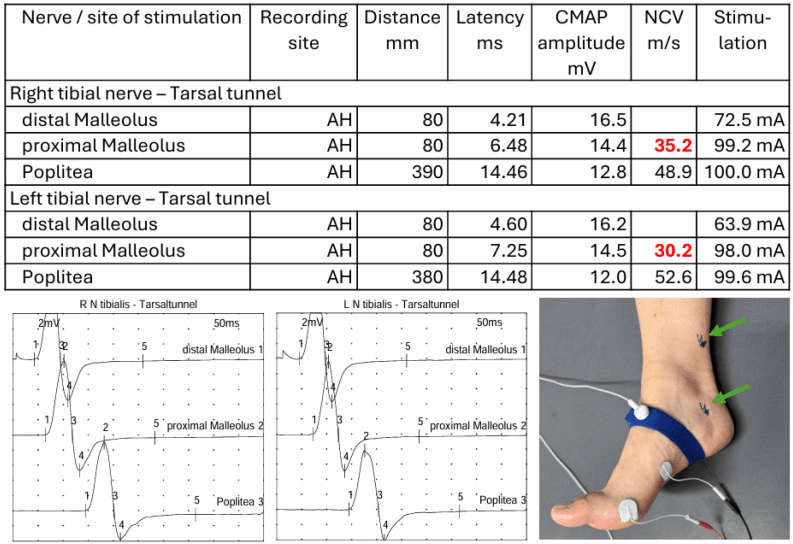 Table and traces of right and left tibial motor nerve conduction recorded from abductor hallucis, stimulated distal and proximal to the malleolus and at the popliteal fossa, with a photograph of the stimulation sites
