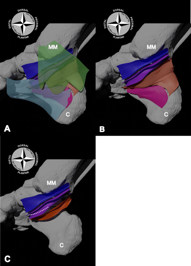 Three-panel digital model of the medial roof of the tarsal tunnel, formed by the flexor retinaculum and abductor hallucis, and the tendon sheaths beneath it
