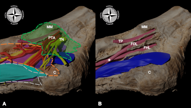 Two-panel digital model of the tarsal tunnel from the medial-plantar side: panel A the flexor retinaculum over the posterior tibial artery and tibial nerve, panel B the tibialis posterior, flexor digitorum longus and flexor hallucis longus tendons
