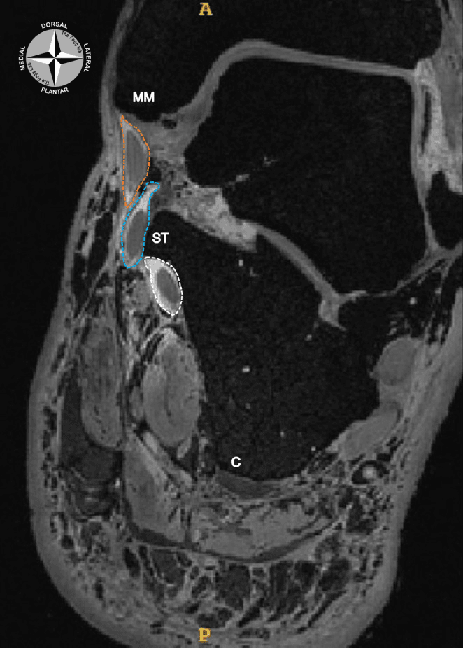 Coronal MRI at the level of the sustentaculum tali with the tibialis posterior, flexor digitorum longus and flexor hallucis longus tendon sheaths outlined in orange, blue and white