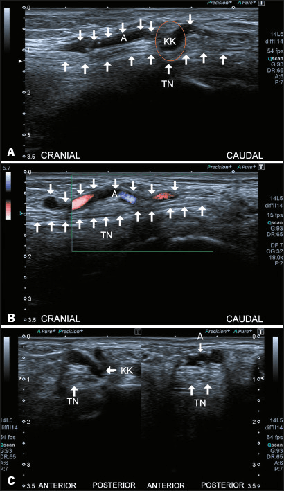 Ultrasound in three panels showing the posterior tibial artery kinking over the tibial nerve, on sagittal views with and without colour Doppler and on axial views