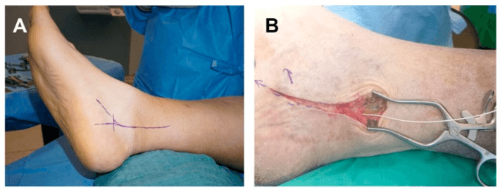 Two intraoperative photographs: the planned incision marked behind the medial malleolus, and the exposed tibial nerve held in white loops