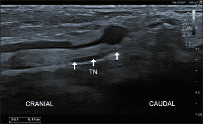 Long-axis ultrasound of a focal dilatation of the tibial vein beside the tibial nerve
