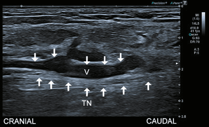 Long-axis ultrasound of dilated malformed tibial veins lying against the tibial nerve
