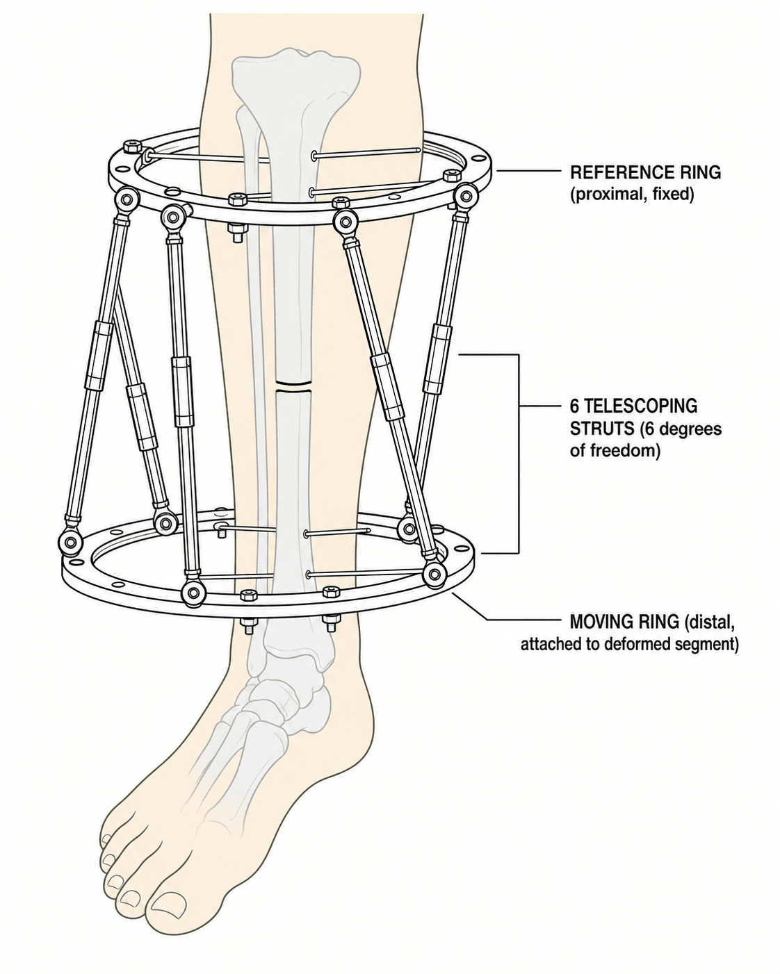 Schematic of a Taylor Spatial Frame hexapod external fixator showing the reference ring, moving ring, and six telescoping struts