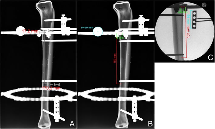 Frame radiographs of a tibia model comparing the axial mounting parameter measured uncalibrated (170.3 mm), with a 30 mm calibration marker (159 mm) and on a calibrated image intensifier (157 mm).