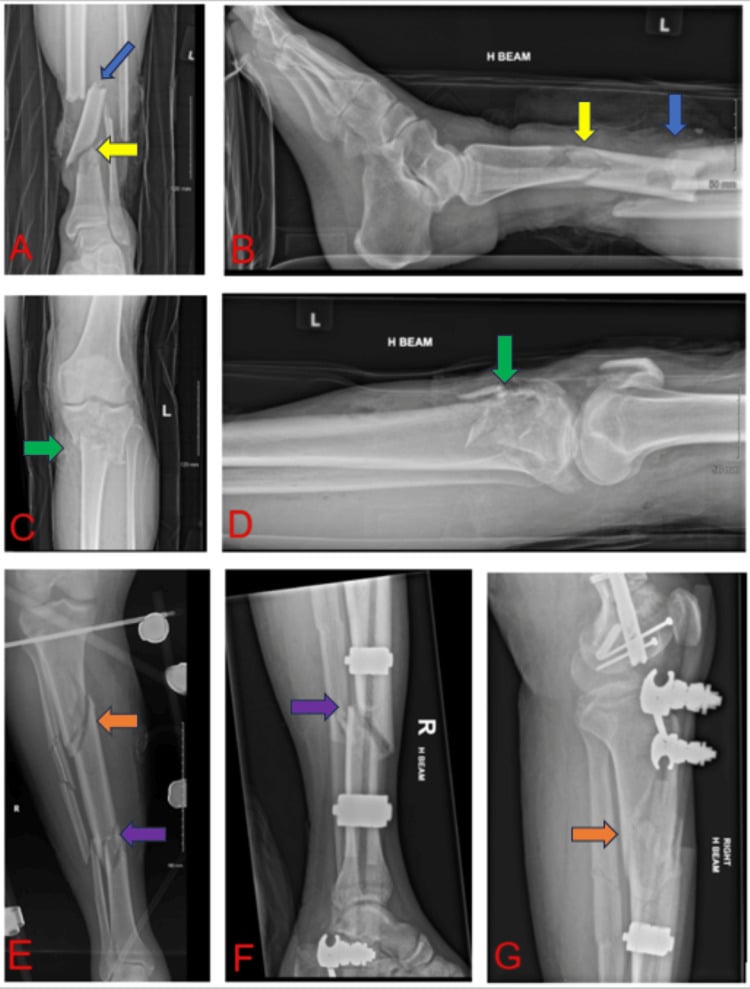 Pre-frame radiographs of multisegmental tibial and fibular fractures, panels A-G, with coloured arrows at the fracture levels; panels A-D are marked L and panels E-G are marked R.