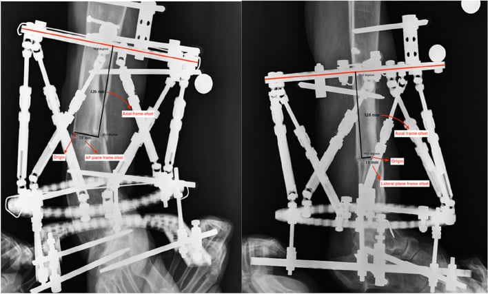 Two frame radiographs annotated with the axial frame offset (126 mm), the origin, and the AP-plane (left) and lateral-plane (right) frame offsets from the proximal reference ring.