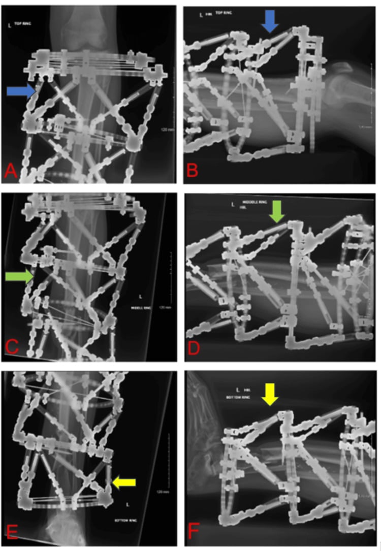 Postoperative radiographs of a triple-stacked Taylor Spatial Frame on a left leg, paired views labelled top ring (A, B), middle ring (C, D) and bottom ring (E, F).