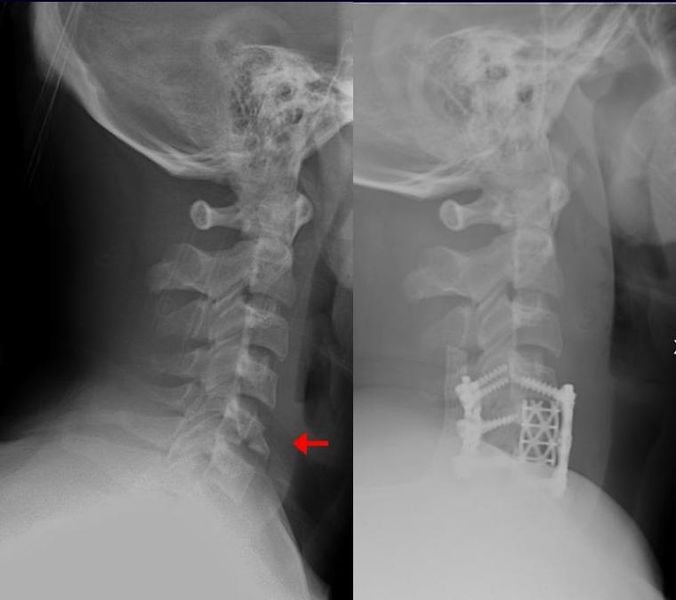 Lateral cervical radiographs of a flexion teardrop fracture before and after anterior fixation.