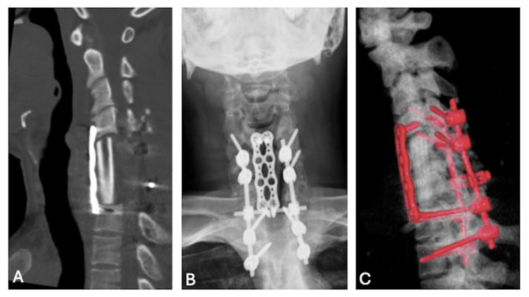 Postoperative CT, radiograph and three-dimensional reconstruction showing anterior corpectomy with cage and plate combined with posterior instrumentation