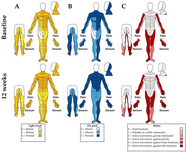 ASIA impairment scale body charts showing light touch, pinprick and motor scores at baseline and at twelve weeks