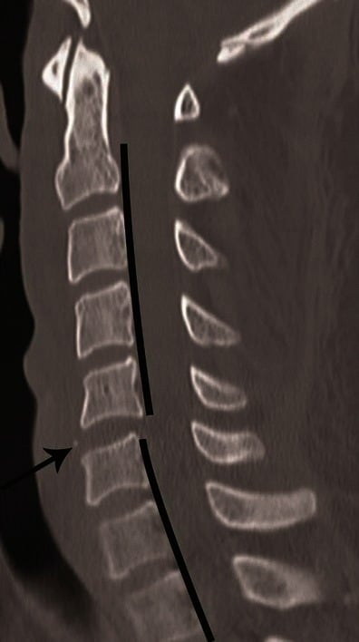 Mid-sagittal CT showing marked prevertebral soft tissue swelling with subtle anterior widening of the C5-C6 disc space in a hyperextension distraction injury
