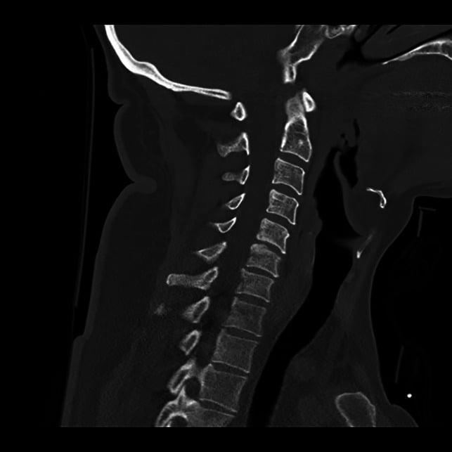 Sagittal cervical CT reconstruction showing an undisplaced right C6 facet fracture graded as AO SLIC morphology F2