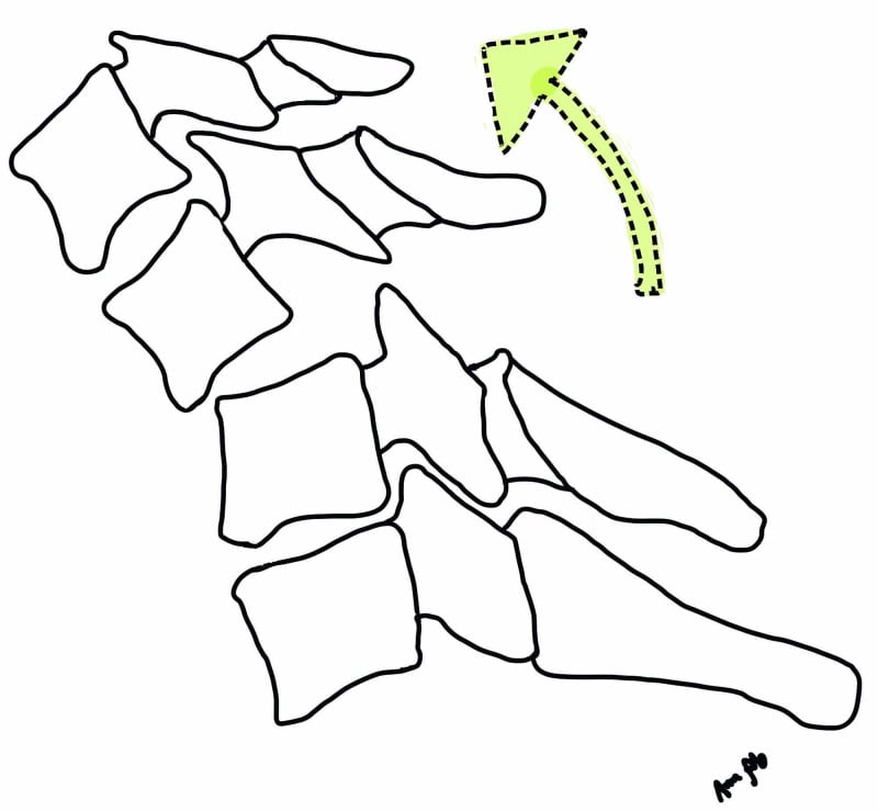 Line illustration of a cervical flexion distraction injury showing anterior vertebral body compression with posterior element distraction and displacement