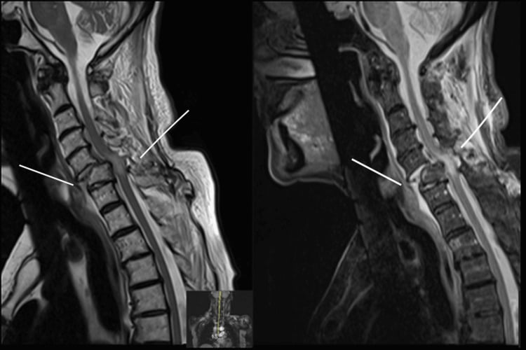 Sagittal MRI showing C5-C6 anterolisthesis with facet dislocation and marked spinal cord compression