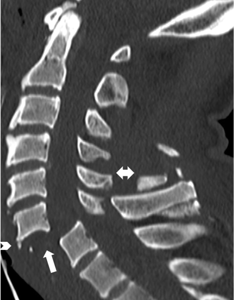 Sagittal cervical CT showing complete translation of C6 on C7 with a teardrop fragment and the floating vertebra sign