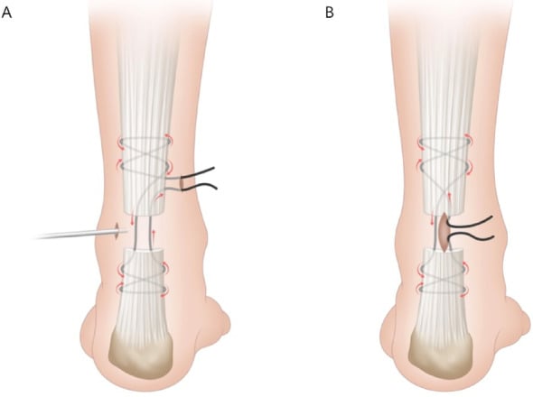 Diagrams comparing endoscopic and minimally invasive modified Bunnell suture configurations for Achilles tendon rupture