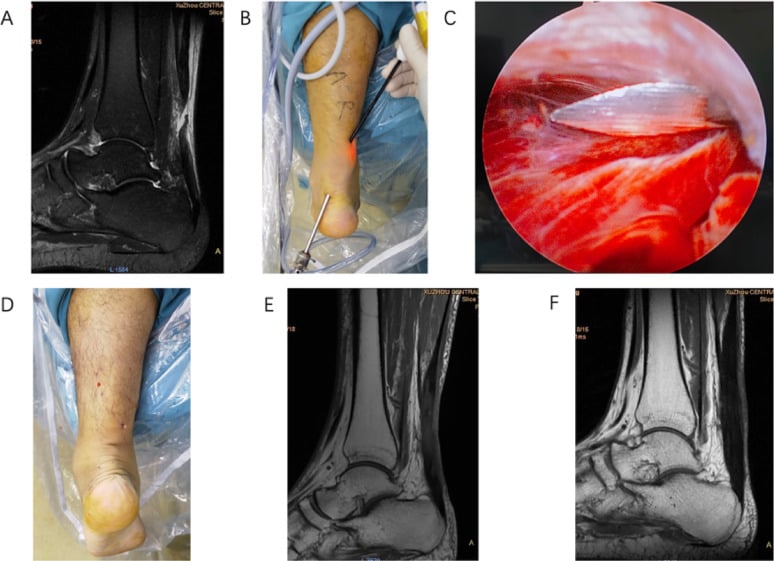 MRI, portal planning, endoscopic view and follow-up MRI for an endoscopic repair of an acute midsubstance Achilles tendon rupture