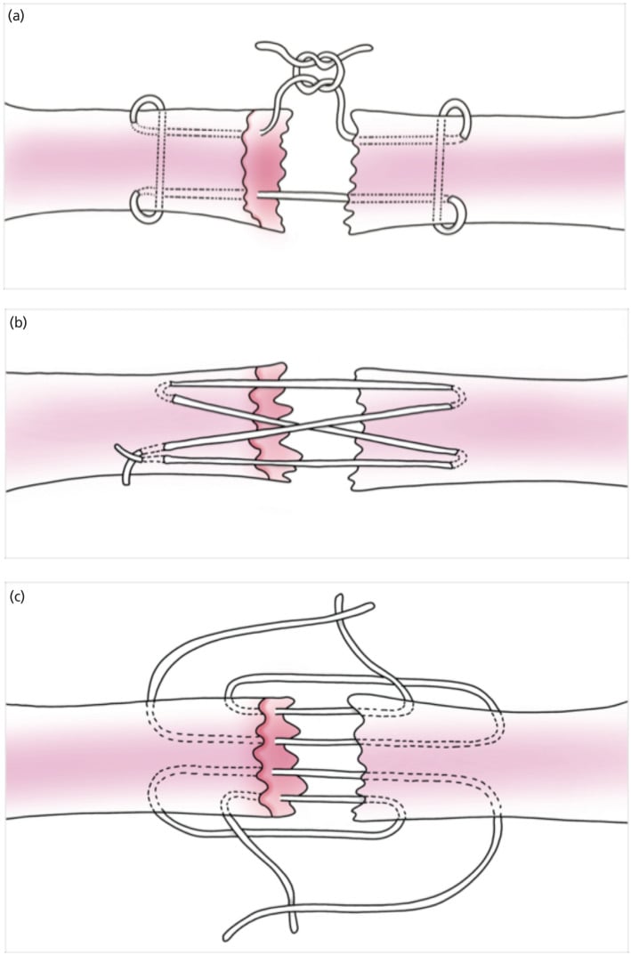 Diagrams of modified Kessler, cruciate and double-loop core suture configurations for tendon repair
