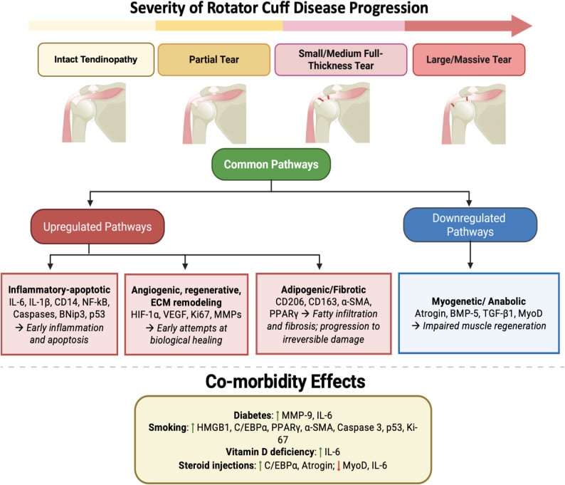 Diagram linking rotator cuff tear progression, molecular healing pathways and modifying effects of diabetes, smoking, vitamin D deficiency and steroid exposure
