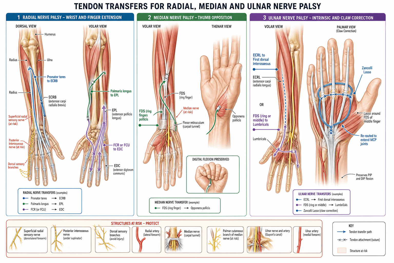 Three-panel labelled illustration of tendon transfers for radial, median and ulnar nerve palsy with the structures at risk.
