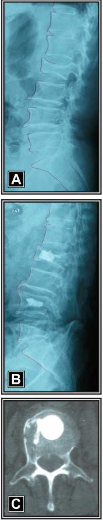 Three-panel imaging: two lateral lumbar radiographs and an axial CT of osteoporotic vertebral compression fractures