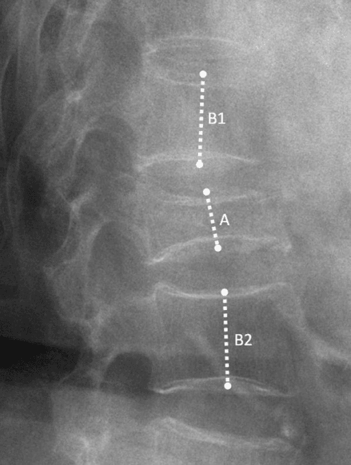 Lateral spine radiograph showing how vertebral height is measured against adjacent intact vertebrae