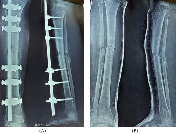 Anteroposterior and lateral radiographs showing persistent fracture lines and minimal healing progression