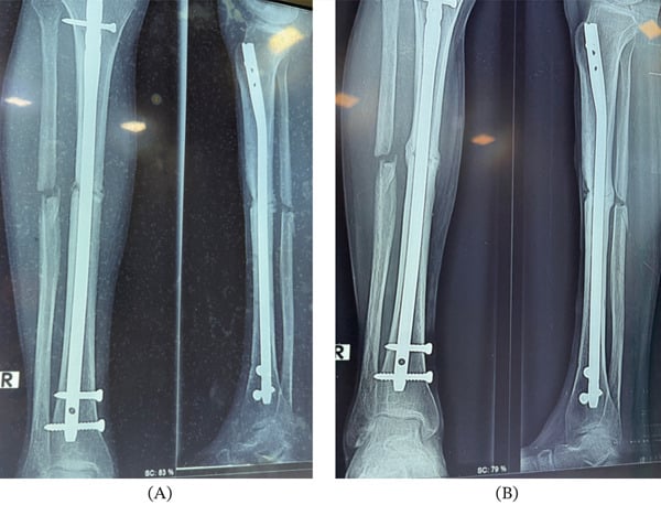 Anteroposterior and lateral radiographs showing bridging callus and advanced fracture healing