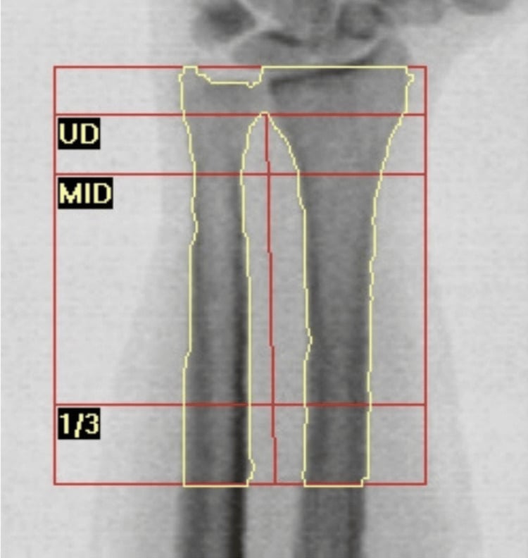 DXA of the distal forearm with ultra-distal, mid-distal and one-third-radius regions of interest outlined