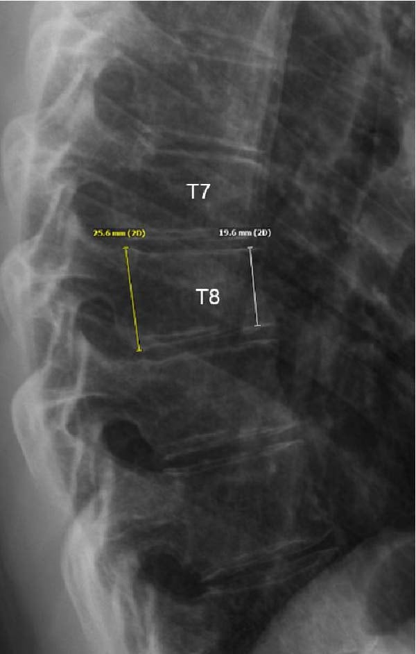 Lateral thoracolumbar radiograph showing anterior compression of T7 and T8 with T8 outlined