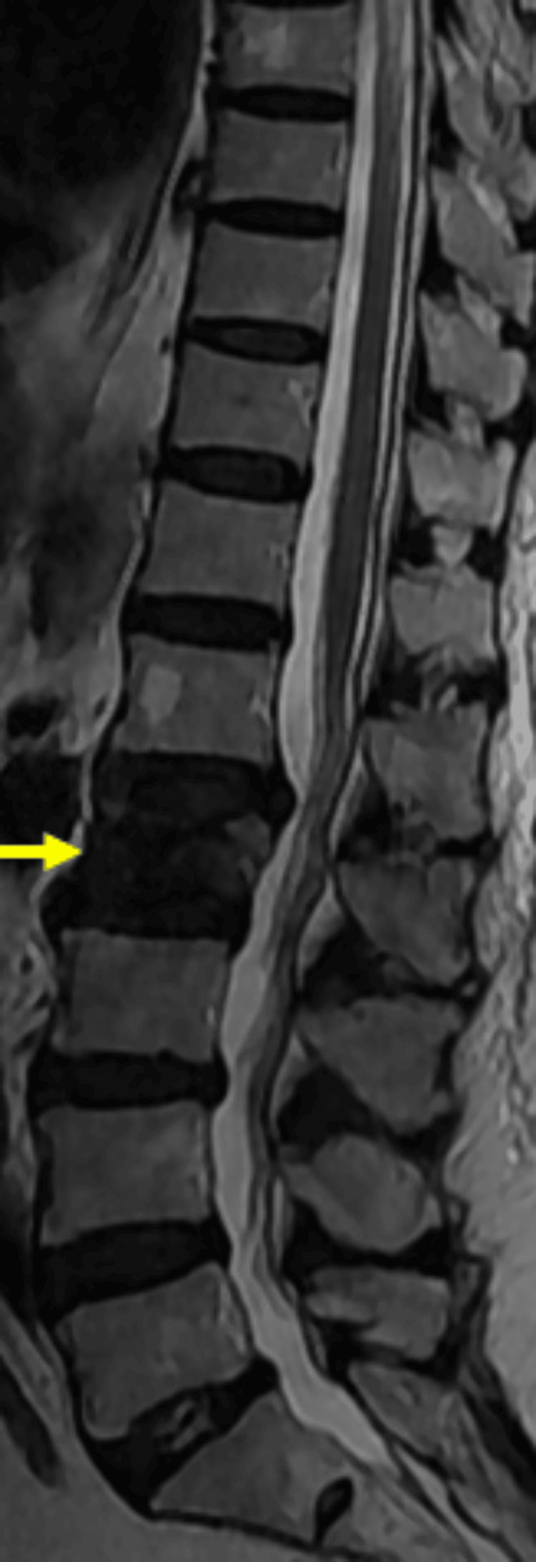Sagittal T2-weighted MRI of the thoracolumbar spine showing an acute osteoporotic compression fracture at L2