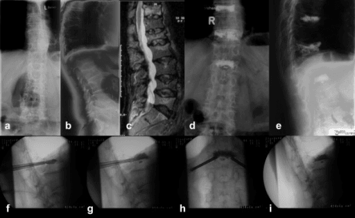 Plain radiographs showing multiple osteoporotic vertebral compression fractures