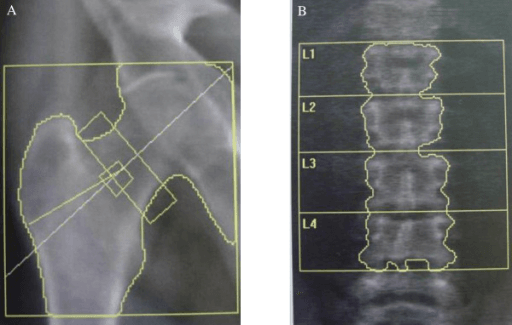 Dual-energy X-ray absorptiometry of the femoral neck and lumbar spine in Fabry disease with regions of interest outlined