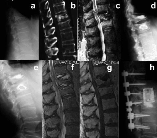 Radiographs and MRI showing multiple thoracolumbar osteoporotic compression fractures in corticosteroid-induced osteoporosis