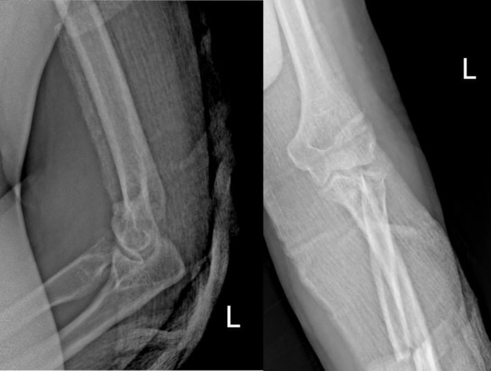 Lateral elbow radiograph demonstrating terrible triad fracture-dislocation