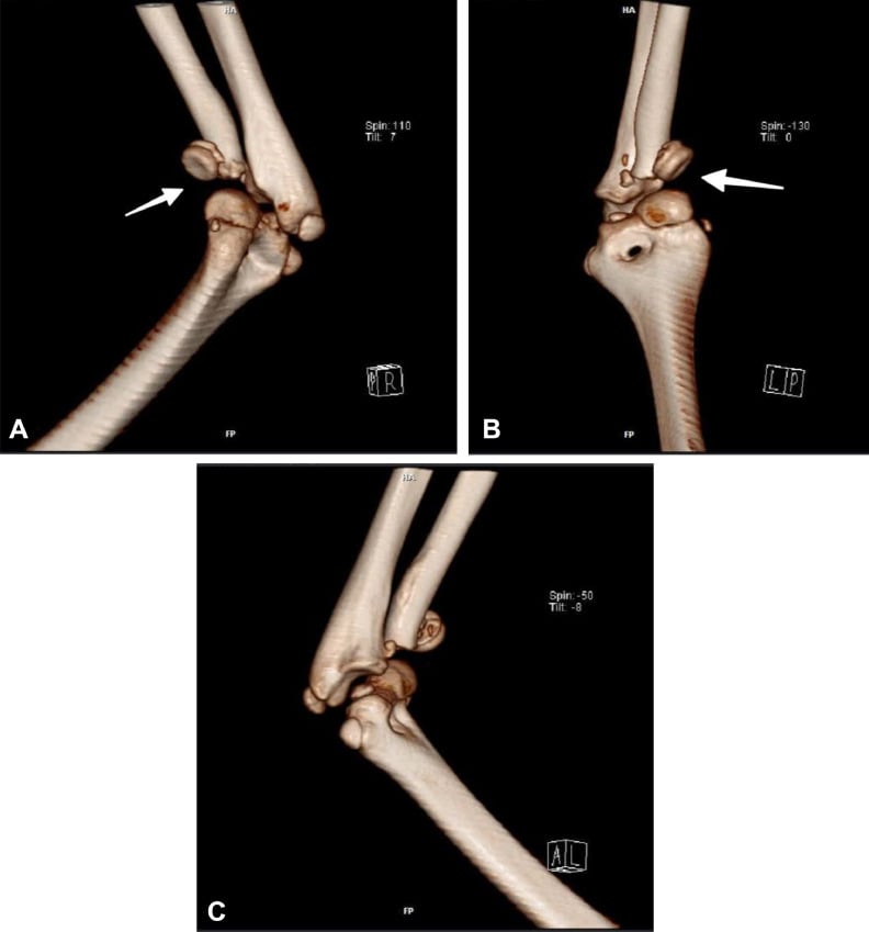 3D CT reconstruction of terrible triad elbow fracture-dislocation