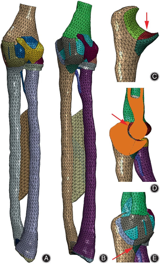 Biomechanical finite element diagram of load distribution in the elbow joint