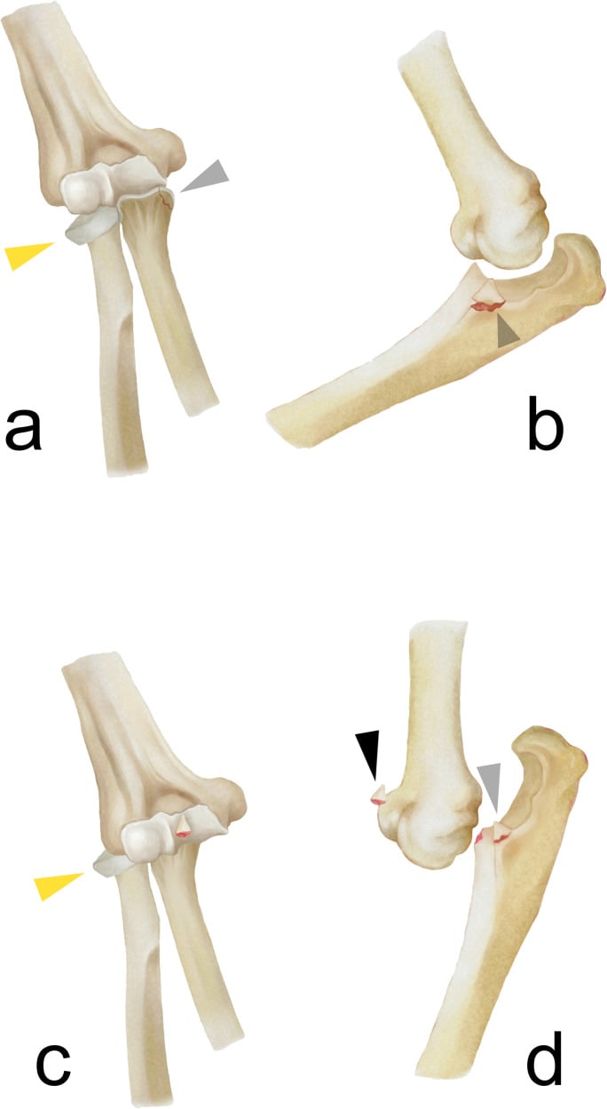 Anatomical diagram of terrible triad elbow injury components