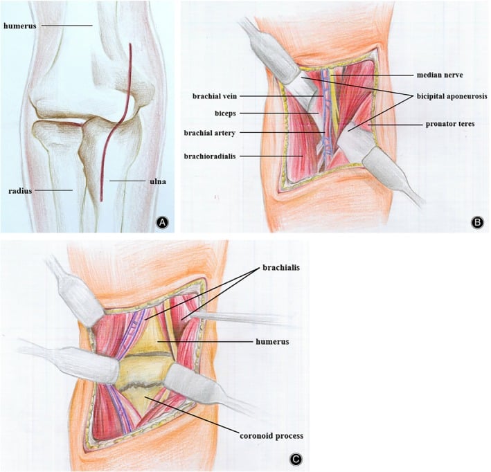 Schematic diagram of surgical approaches and surgical anatomy for terrible triad elbow repair