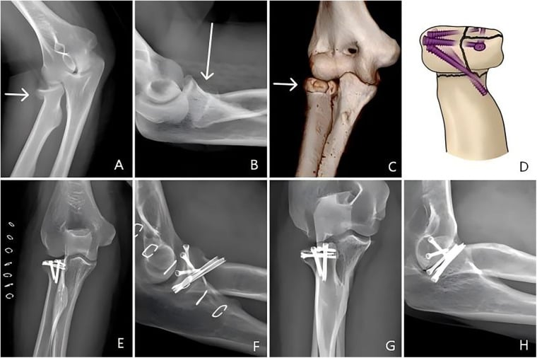 Preoperative and postoperative radiographs of radial head screw fixation in terrible triad injury