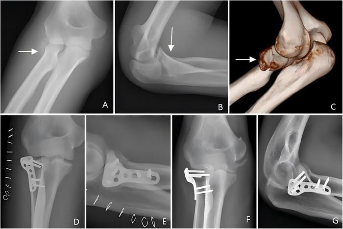 Preoperative and postoperative radiographs of radial head locking plate fixation
