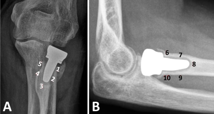 Radiographs showing periprosthetic radiolucency zones around a radial head replacement
