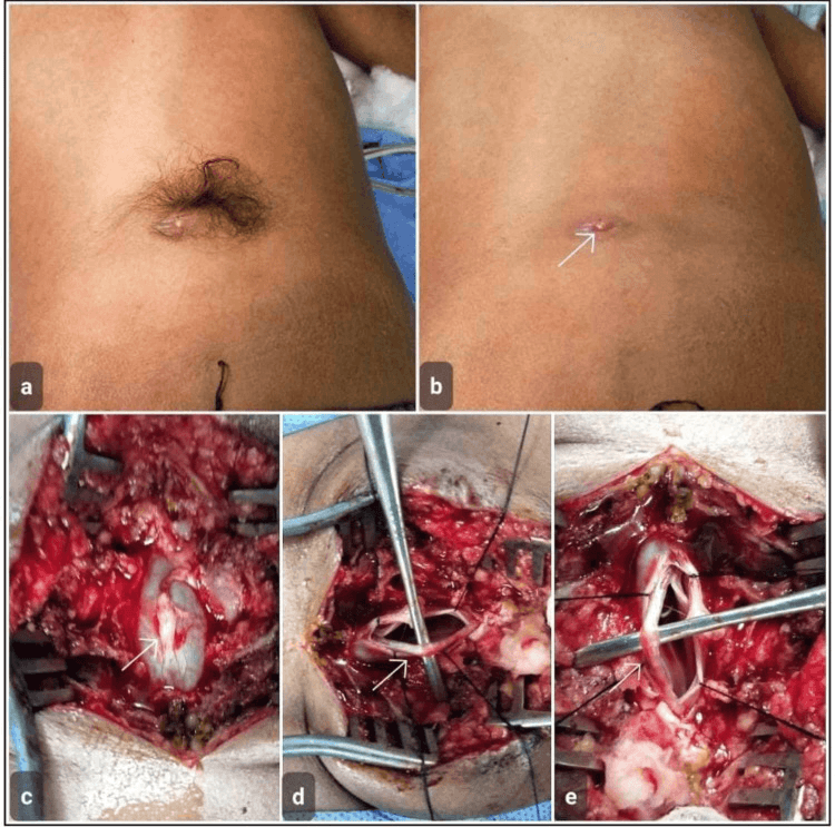 Clinical photograph of a midline lumbosacral cutaneous pit with a surrounding hair tuft marking a dermal sinus tract