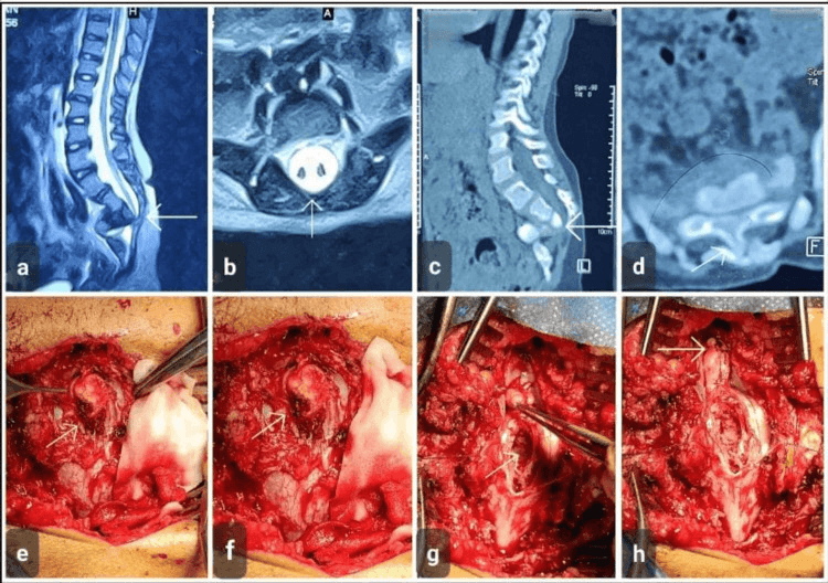 Sagittal and axial T2 MRI showing spinal cord duplication within a single dural sac in diastematomyelia