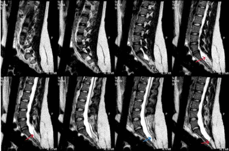 Sagittal T2 MRI showing a lipomyelomeningocele with tethered cord